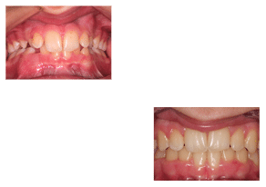 orthodontist results monmouth county nj