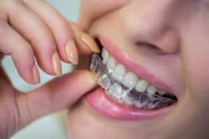 Cost of Invisalign in Monmouth