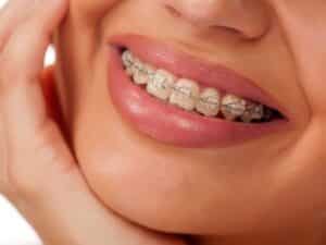 ceramic braces vs Invisalign