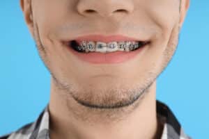 Cost of Braces in NJ