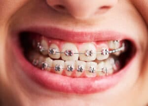 Teen vs Adult Braces: Powerful Solutions for Every Age