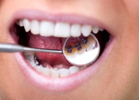 Lingual Braces Breakdown: A Smart Choice for a Hidden Smile Fix