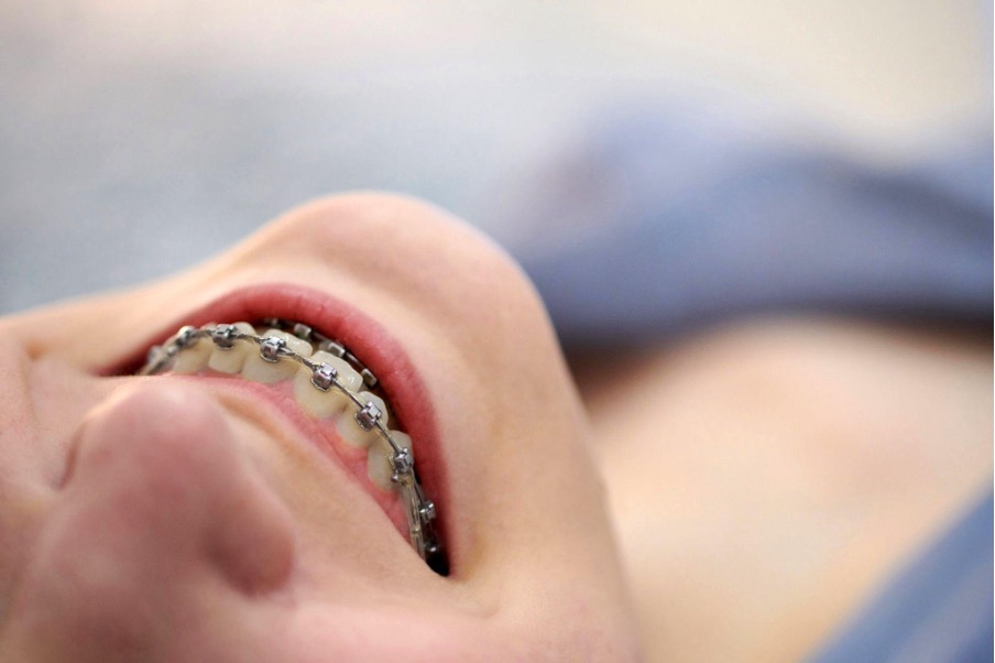 Cost of Braces in Oakhurst: 5 Valuable Factors to Consider