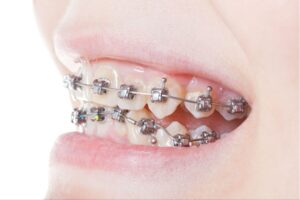 Braces Travel Guide: Expert Advice for Stress-Free Care