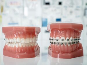 Invisalign Jersey Shore: Expert Insights to Help You Decide